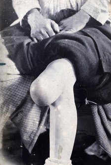 Friern Hospital, London: the knee of a seated person, with a large growth,  1890-1910. Creator: Unknown.