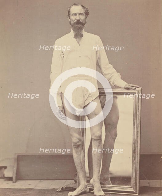 Gunshot Wound of Middle Third of Left Femur, 1865-67. Creator: William H. Bell.