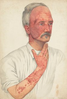 A man with disease designated as Lupus erythematosus, 1902. Creator: Mabel Green.