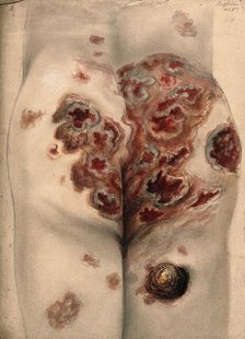 Severely diseased tissue on the buttocks and thighs of a man, 1867. Creator: Christopher D'Alton.