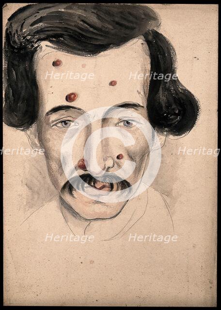 Head of a man with a disease affecting his face, 1800-1899. Creator: Christopher D'Alton.