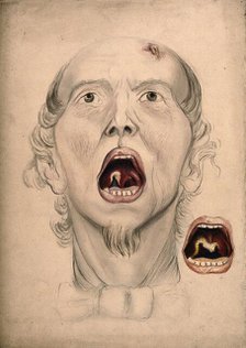 The face of a man, with mouth open wide, displaying a diseased area of tissue on the soft..., 1866. Creator: Christopher D'Alton.