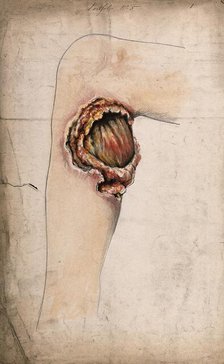 Severely diseased area of tissue on the calf of a woman's leg, (18)58. Creator: Christopher D'Alton.
