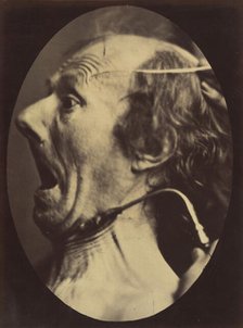 Figure 63: Expression of terror, 1854-56, printed 1862. Creators: Duchenne de Boulogne, Adrien Alban Tournachon.