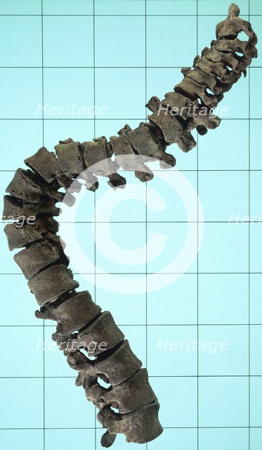 Spinal column showing the curvature of the spine. Artist: Unknown