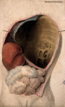 A dissected thorax with a collection of pus in the cavity, c1824. Creator: Unknown.