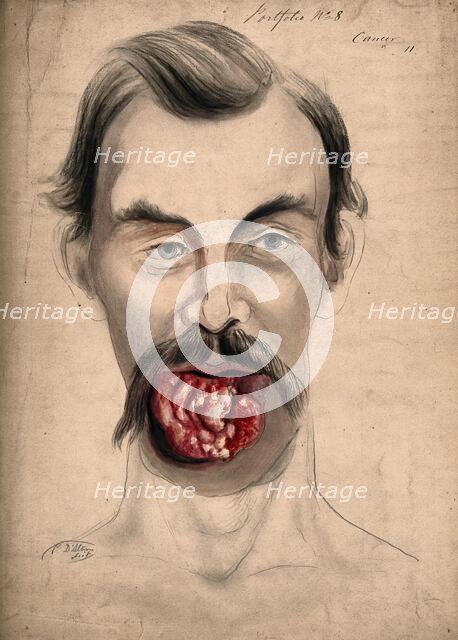 The face of a man suffering from cancer of the tongue, showing severely diseased tissue..., 1867. Creator: Christopher D'Alton.