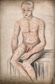 A seated man suffering from a mottled rash of sores, which covers his entire body and face, 1858. Creator: Christopher D'Alton.