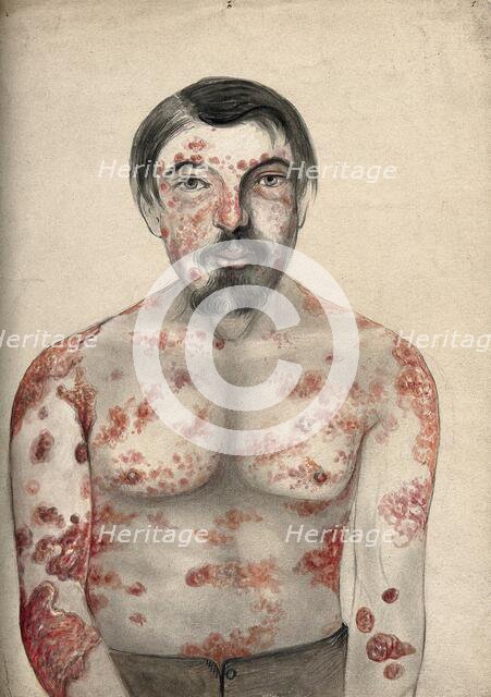 Diseased tissue on the face, shoulders arms and torso of a man suffering from psoriasis..., (18)66. Creator: Christopher D'Alton.