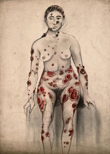 A woman suffering from open sores and abcesses on her face and entire body, 1867. Creator: Christopher D'Alton.