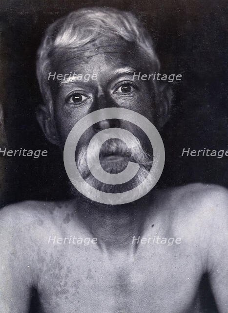 Friern Hospital, London: a patient, facing forwards, 1890/1910. Creator: Unknown.