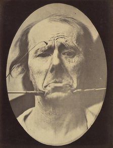 Figure 45: Pain and despair. , 1854-56, printed 1862. Creators: Duchenne de Boulogne, Adrien Alban Tournachon.