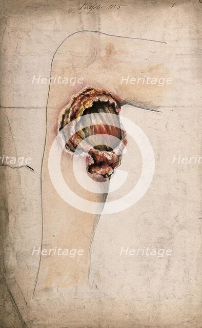 Severely diseased area of tissue on the calf of a woman's leg, (18)58. Creator: Christopher D'Alton.