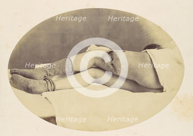 Judson C. Albright, 1865. Creator: Reed Brockway Bontecou.