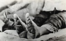 Feet of a Chinese woman, showing the effect of foot-binding, between 1900 and 1999. Creator: Unknown.