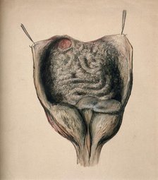 Dissection of diseased intestines, (1851?). Creator: Unknown.