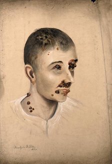 Head of a woman with a severe disease affecting her face and neck, 1864. Creator: Christopher D'Alton.