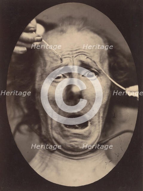 Electro-Physiologie, Figure 64, 1854-56, printed 1862. Creator: Adrien Alban Tournachon.