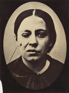 Figure 50: Affected weeping and face in repose, 1854-56, printed 1862. Creators: Duchenne de Boulogne, Adrien Alban Tournachon.